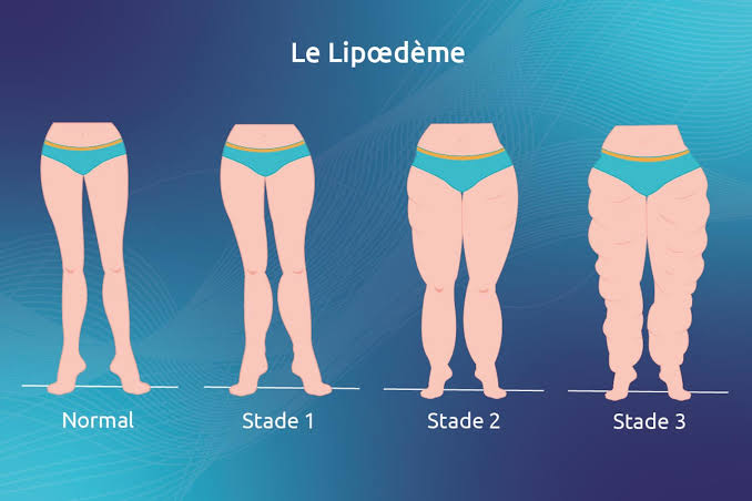 Lipœdème : une maladie encore méconnue au Maroc, la voie de la prise en charge en Espagne